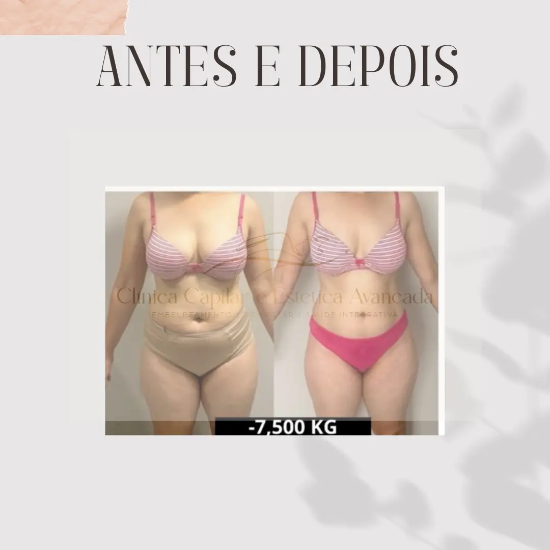 Antes e depois do Protocolo de Emagrecimento — menos 7,5 kg