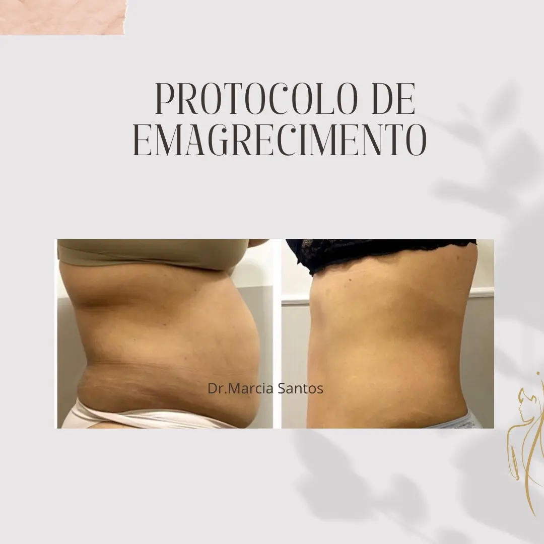 Antes e depois do tratamento de flacidez abdominal