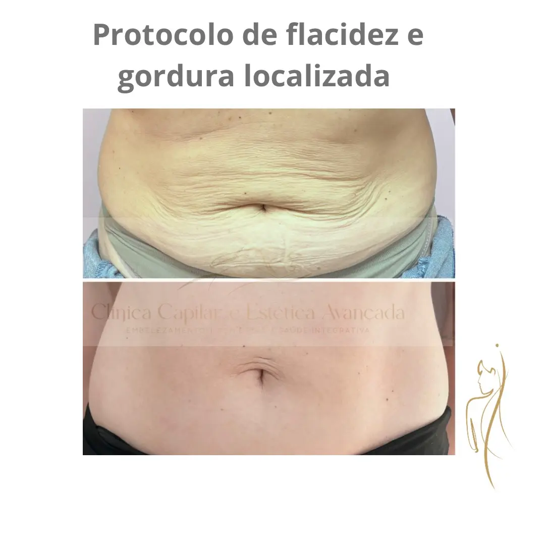 Antes e depois do protocolo de emagrecimento lateral