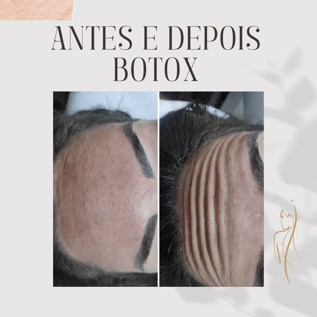 Botox antes e depois — glabela