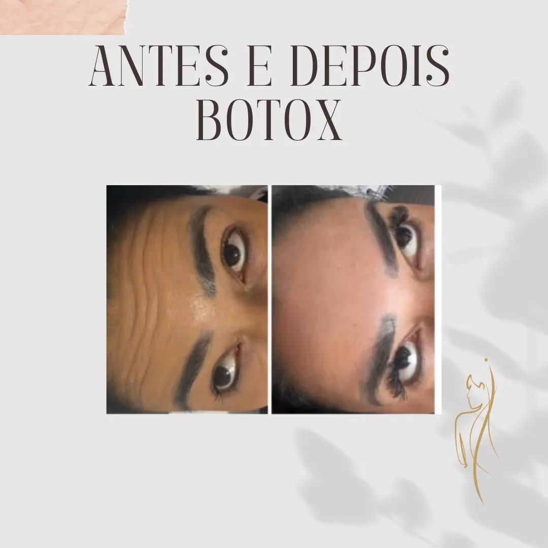 Botox antes e depois — região entre sobrancelhas