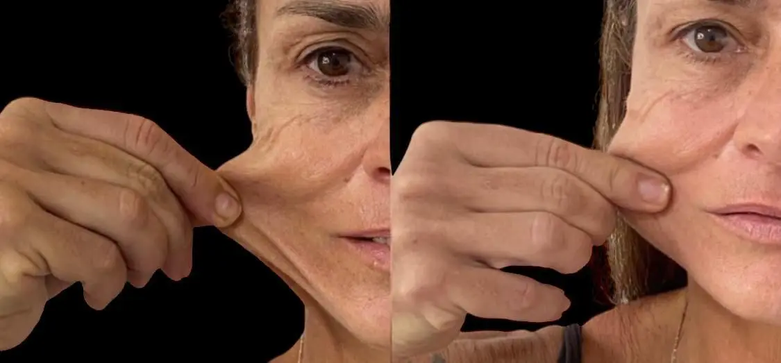 Antes e depois flacidez e gordura localizada