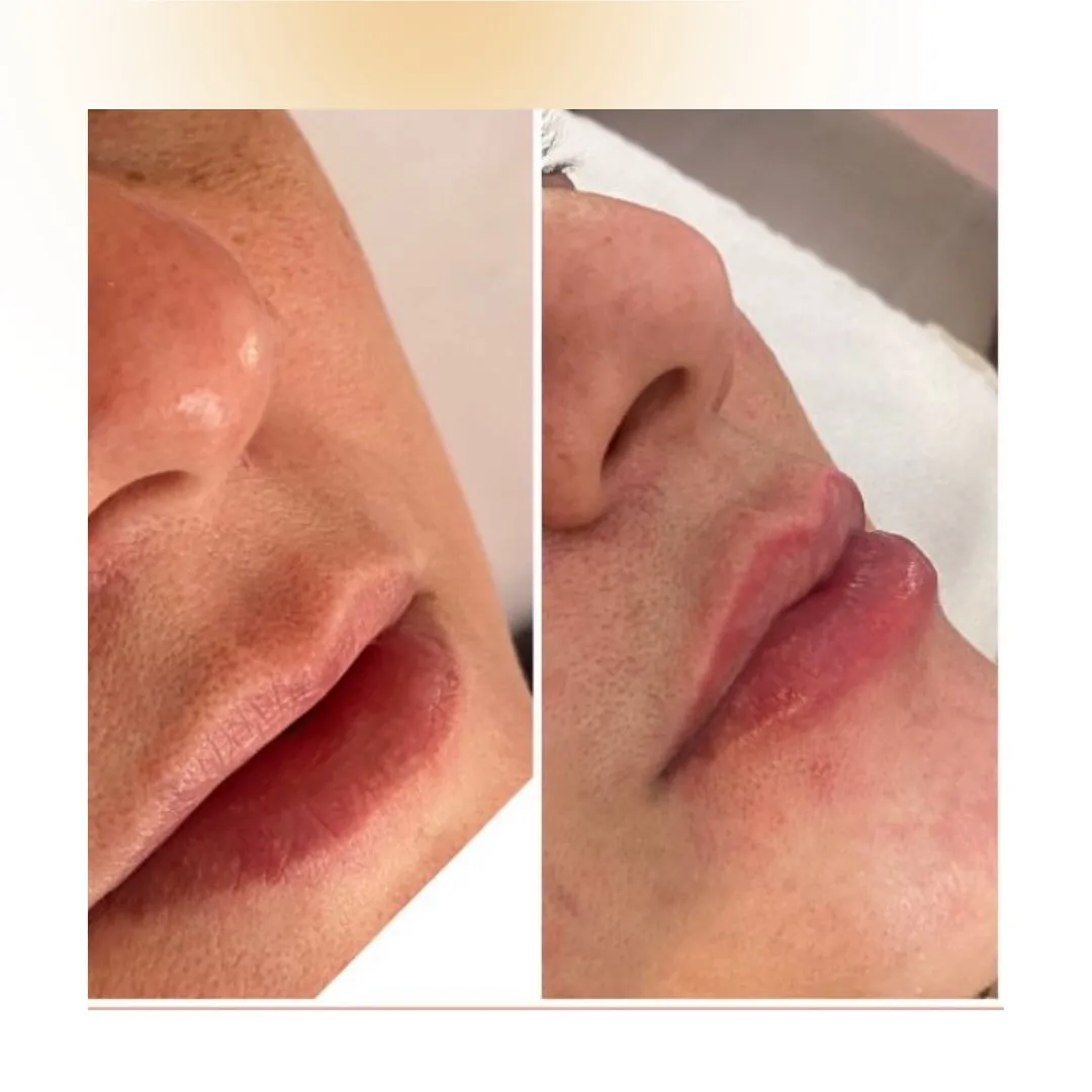 Preenchimento labial