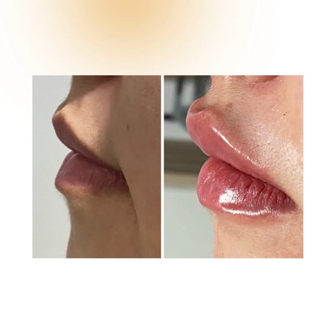 Preenchimento labial resultado